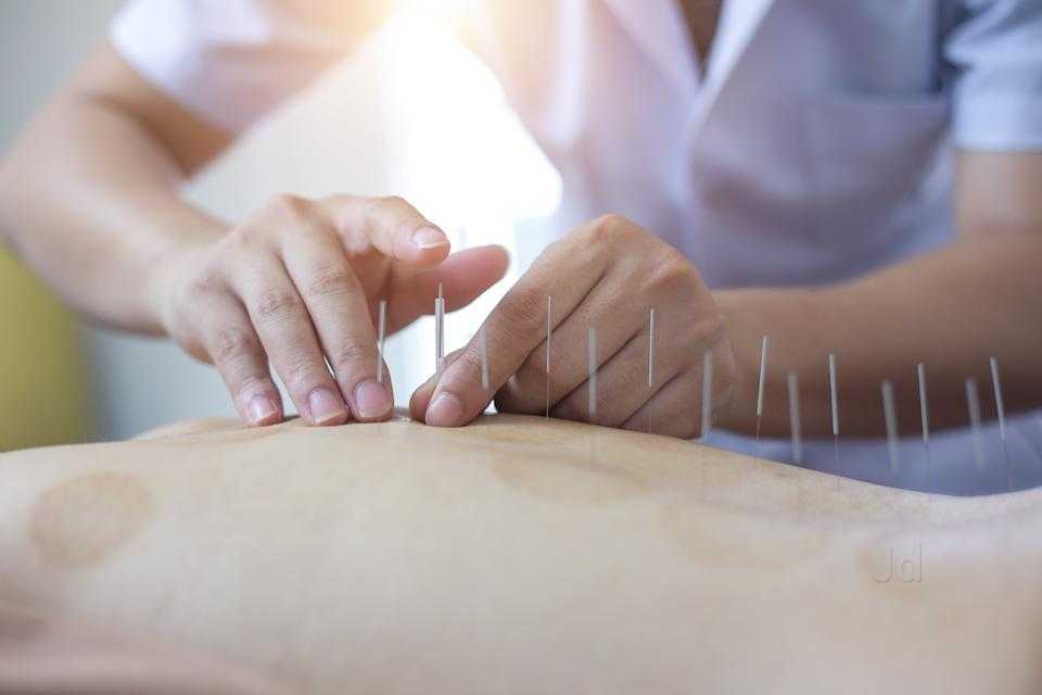 Acupuncture Therapy in Ahmedabad